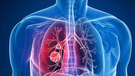 為什么肺部易得癌？每天定量補(bǔ)硒有用嗎？