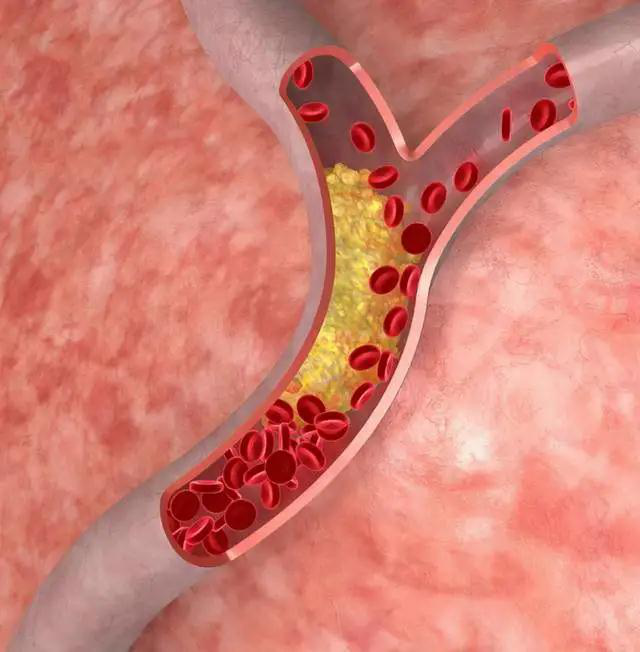 血管堵塞，身體會(huì)有這些癥狀，吃點(diǎn)冬蟲夏草降壓降脂護(hù)血