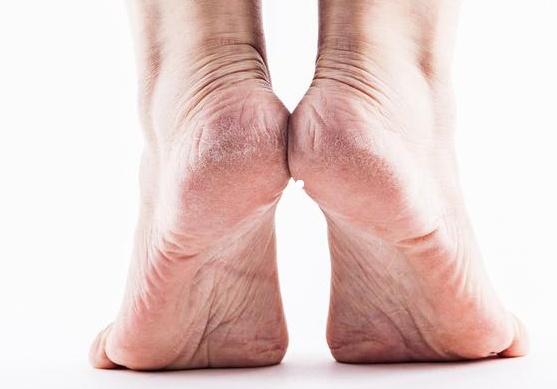 腳后跟經(jīng)常起皮開裂，是缺乏維生素嗎