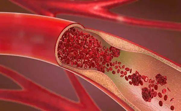 長期服用他汀類患者為什么要補(bǔ)充輔酶Q10？